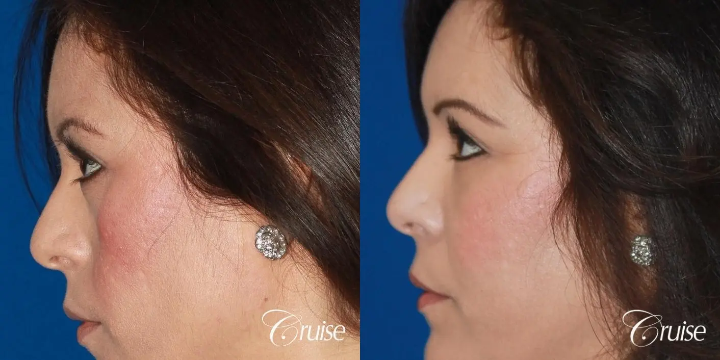 Fat Transfer - Face: Patient 25 - Before and After 2