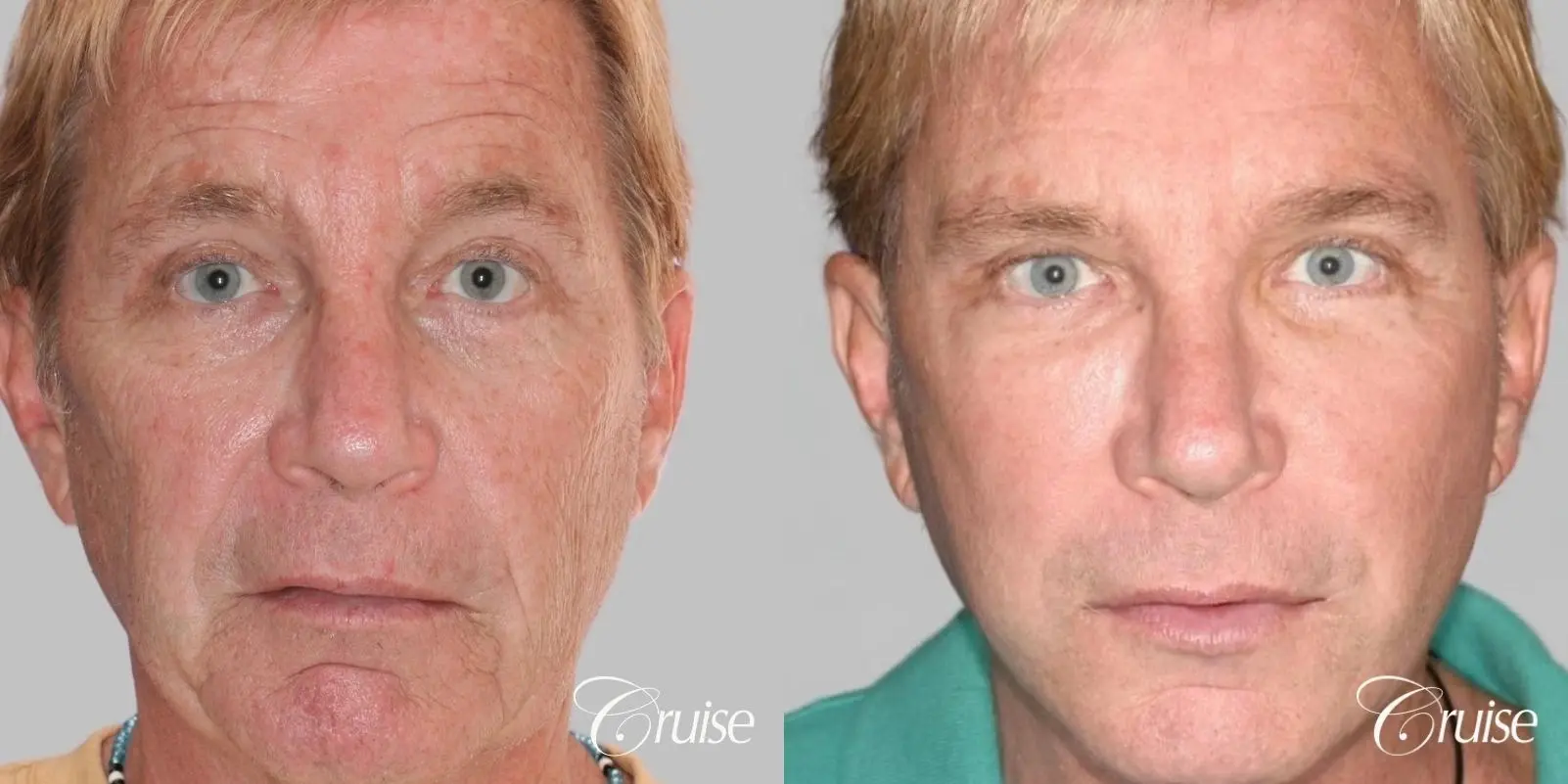 Male Facelift, Browlift, and Fat Transfer - Before and After 1