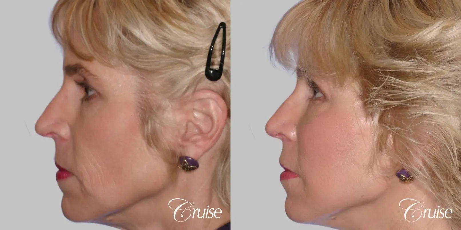 Facelift in Newport Beach, CA - Before and After 2