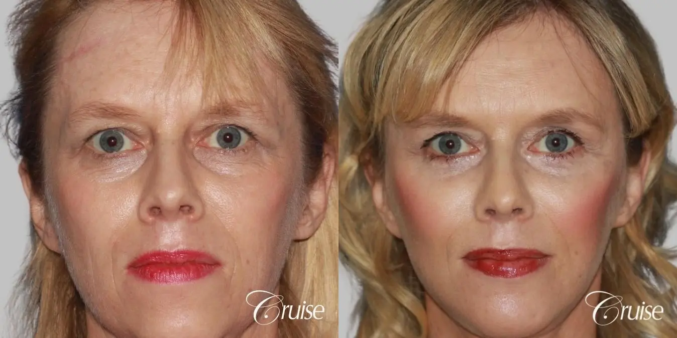 facial rejuvenation newport beach ca - Before and After 1
