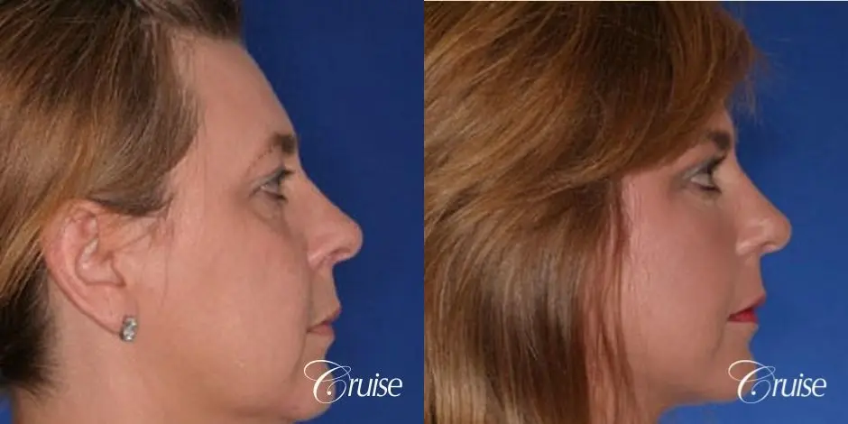 Fat Transfer - Tear Trough, Lower-Lids - Before and After 2