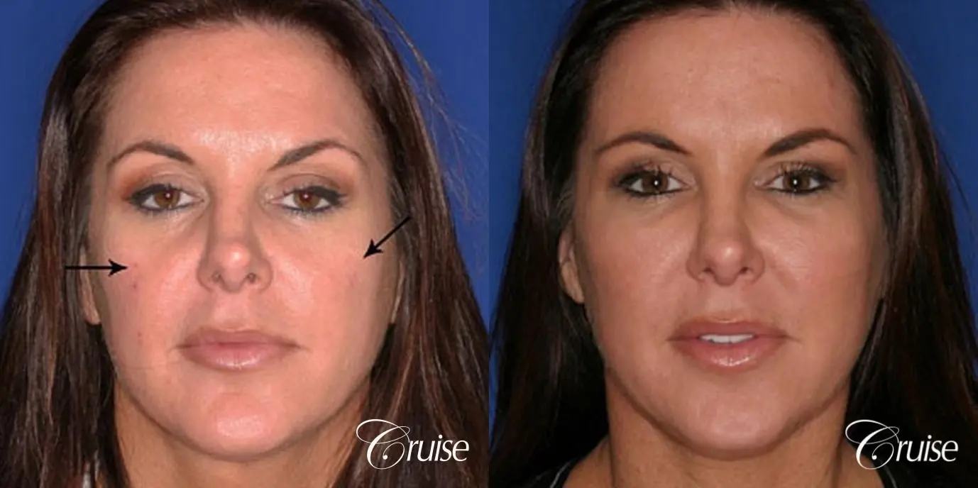 Fat Transfer - Temple, Tear Trough, Lower Lids, Cheeks - Before and After 1