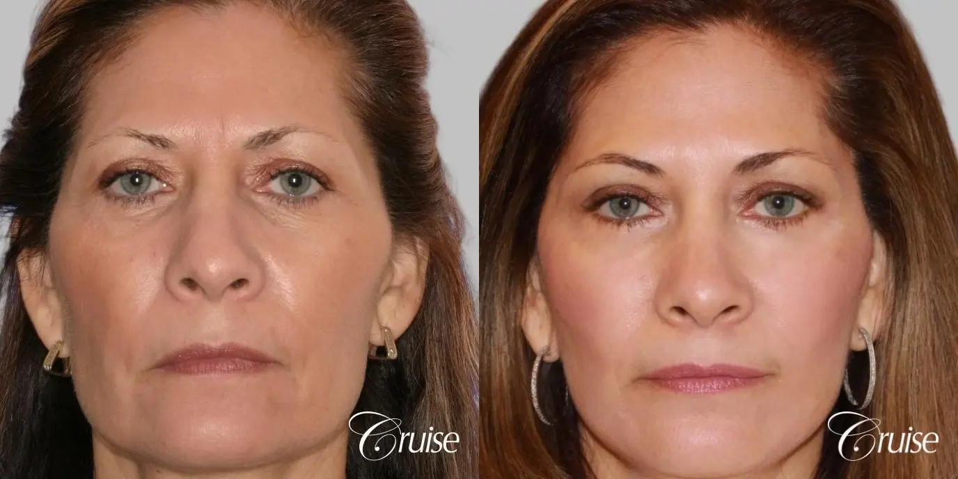 Face Lift, Fat Transfer, Temple Lift - Before and After 1