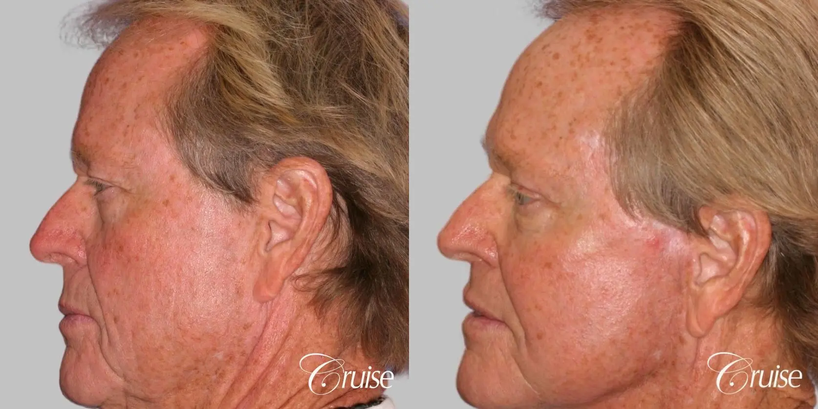 Male Facelift, Necklift, Fat Transfer, Temple Lift - Before and After 3