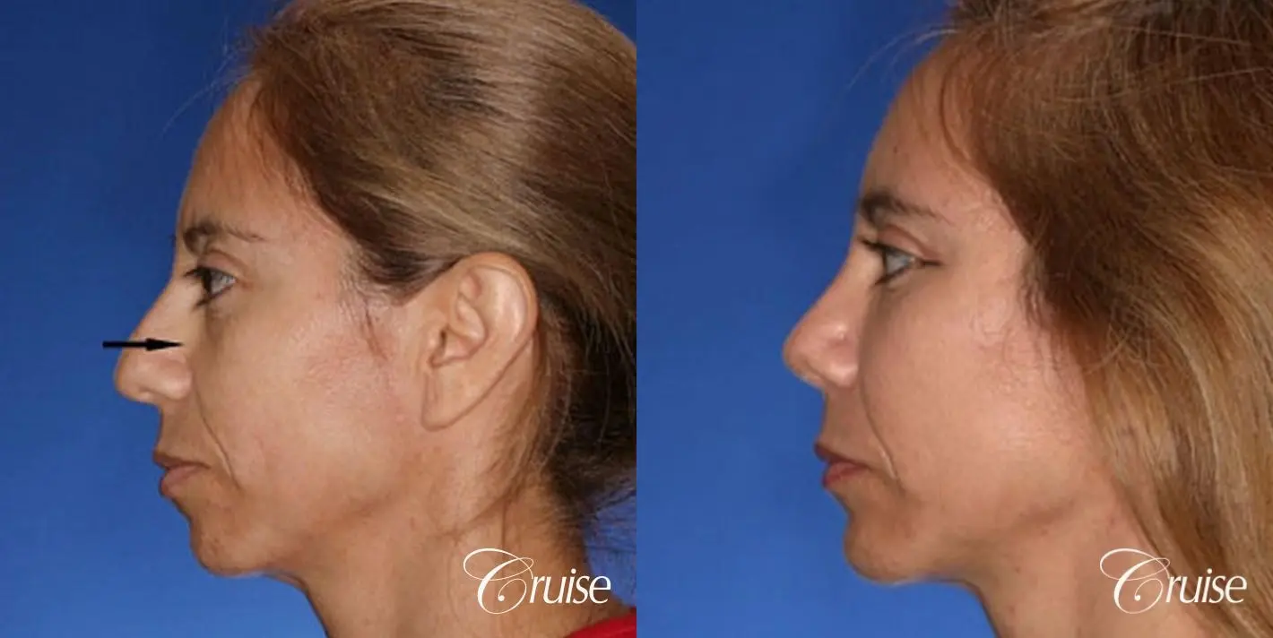 Fat Transfer - Tear Trough, Forehead, Upper Lids, Cheeks - Before and After 2
