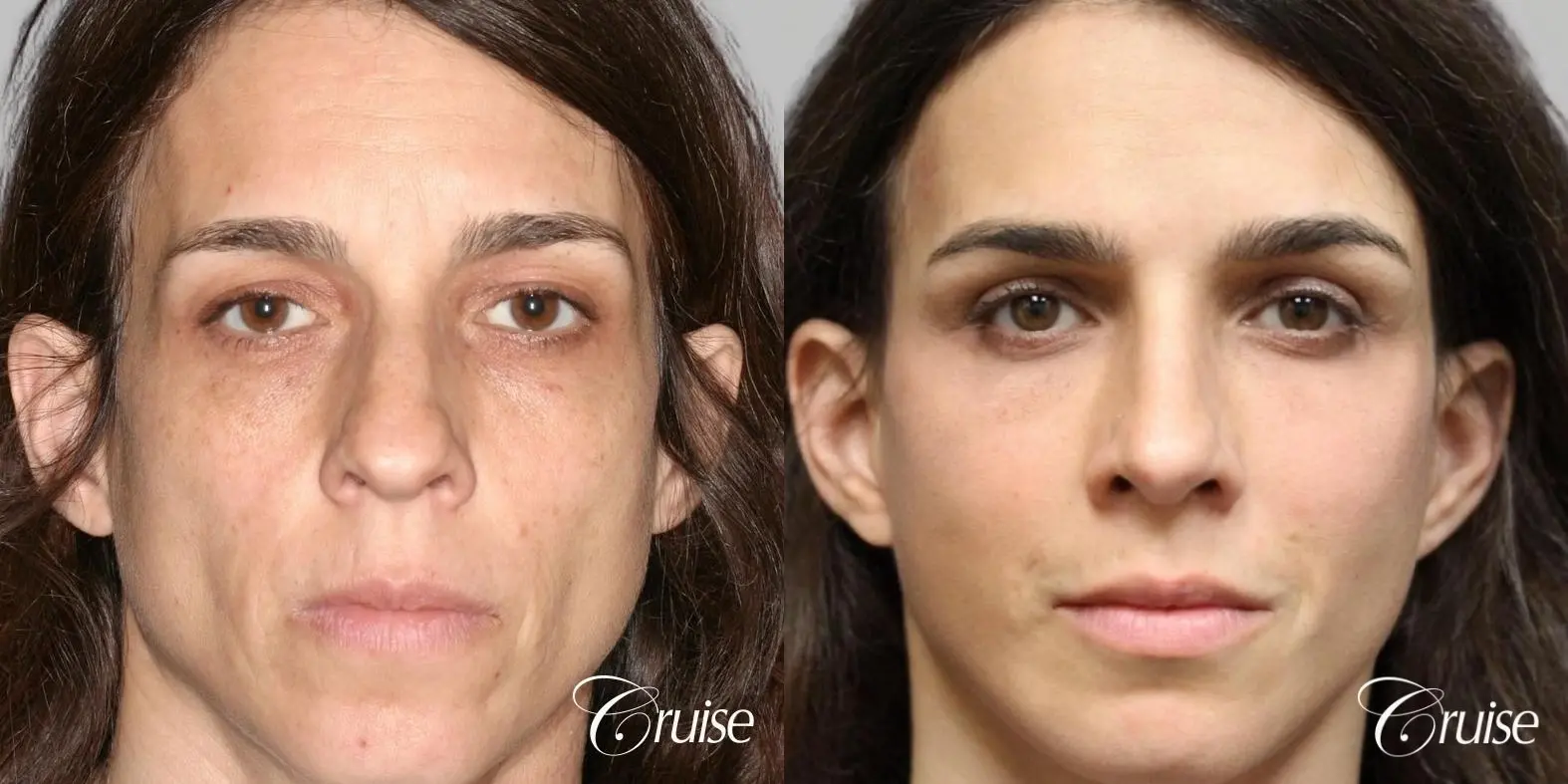 complete facial rejuvenation orange county - Before and After 1