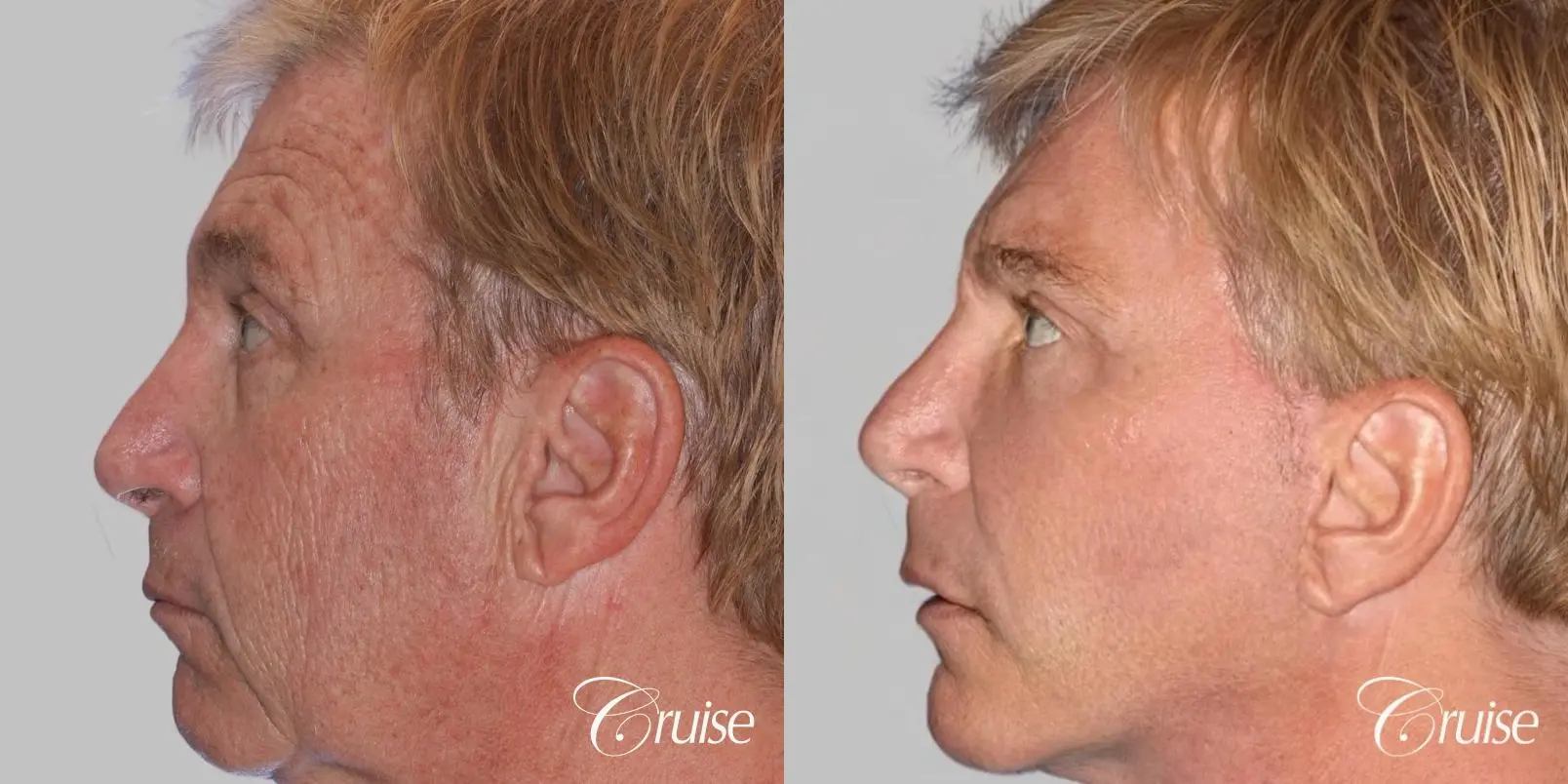 Male Facelift, Browlift, and Fat Transfer - Before and After 3