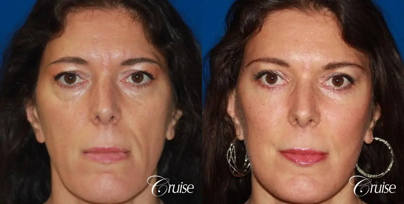 Fat Transfer - Forehead, Temple, Tear Trough, Lower Lids, Cheeks - Before and After 1