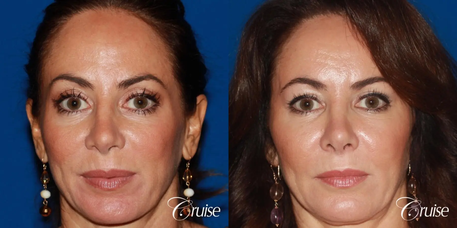 Fat Transfer - Face: Patient 36 - Before and After 1