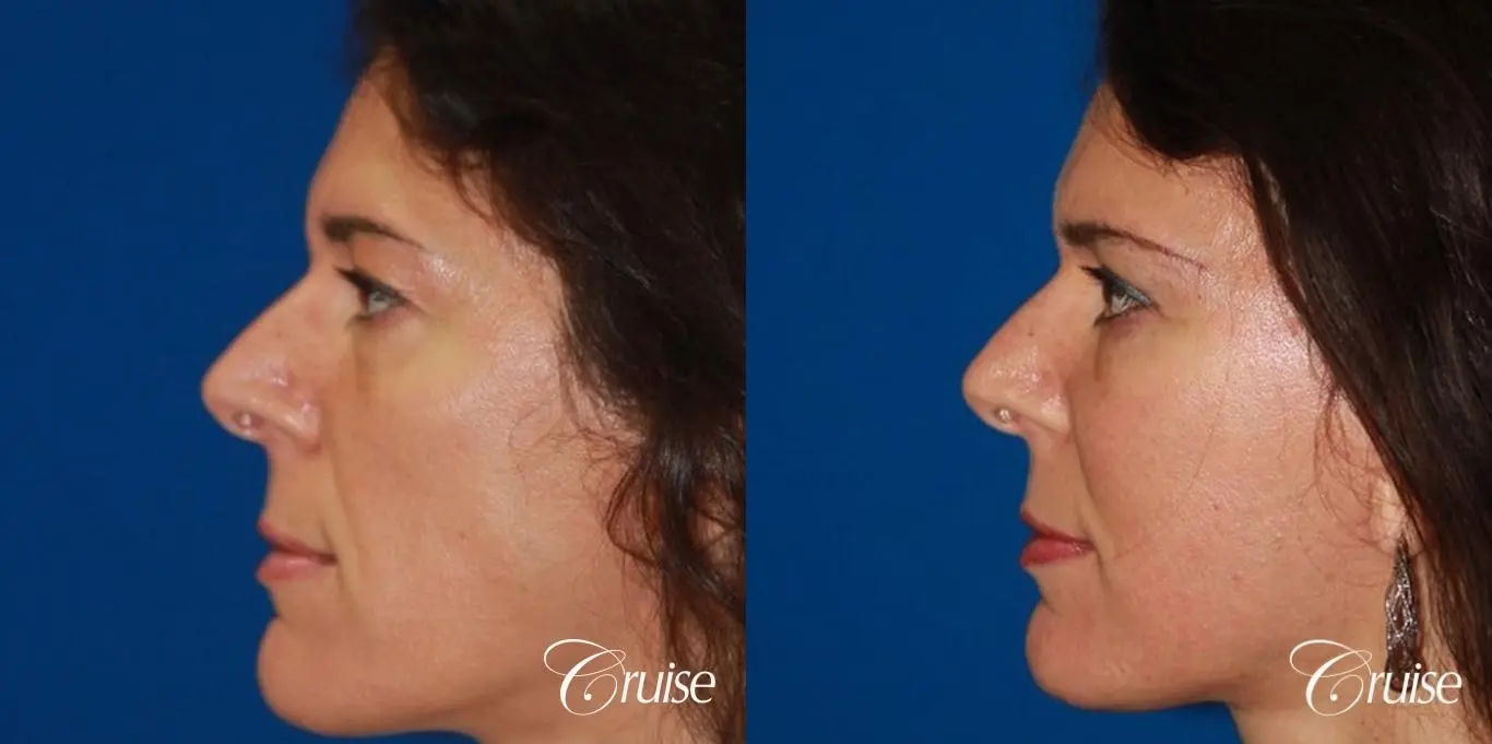 Fat Transfer - Forehead, Temple, Tear Trough, Lower Lids, Cheeks - Before and After 3