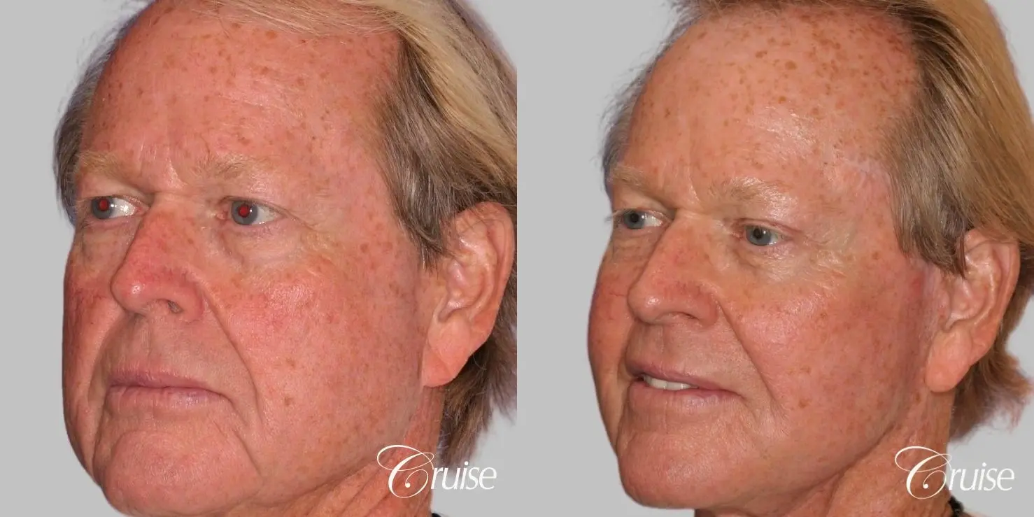 Male Facelift, Necklift, Fat Transfer, Temple Lift - Before and After 2