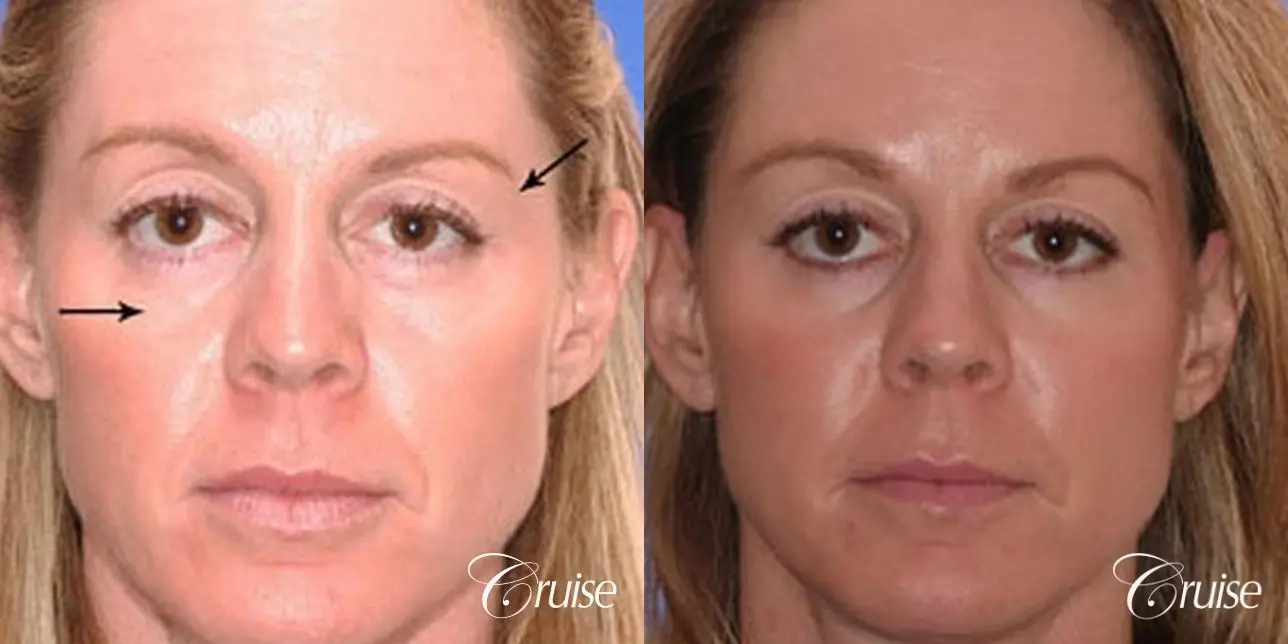 Fat Transfer - Temple, Tear Trough, Lower-Lids, Cheeks - Before and After 1