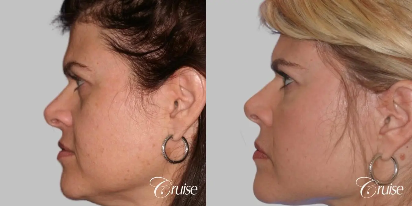 Facelift, Necklift, Temple Lift, Upper Eyelid Surgery, Fat Transfer, Buckle Fat Removal - Before and After 3