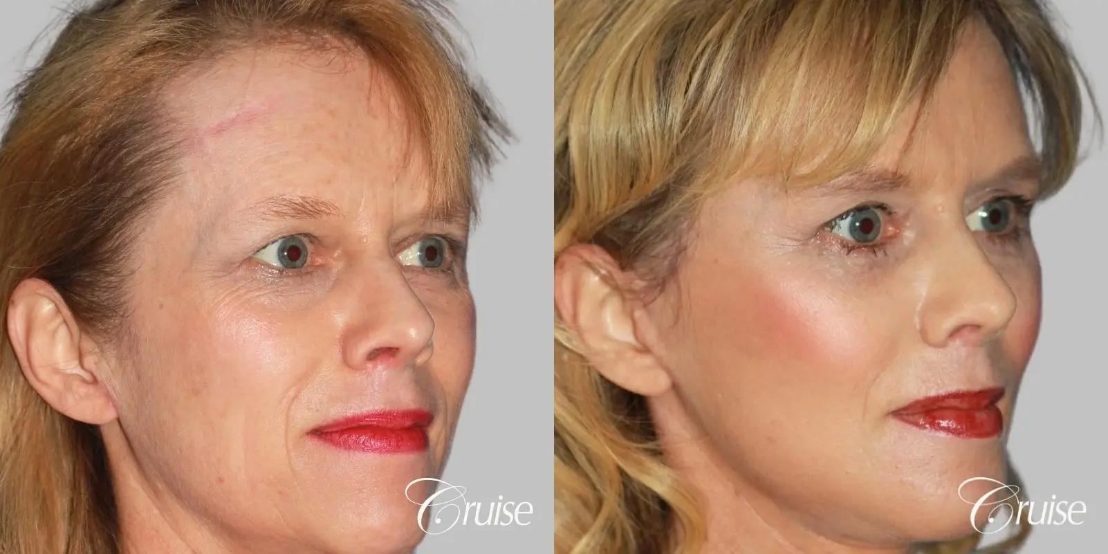 facial rejuvenation newport beach ca - Before and After 3