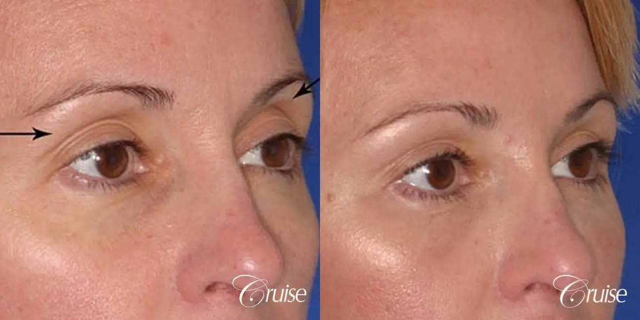 Fat Transfer - Tear Trough, Upper-Lids, Temple - Before and After 3