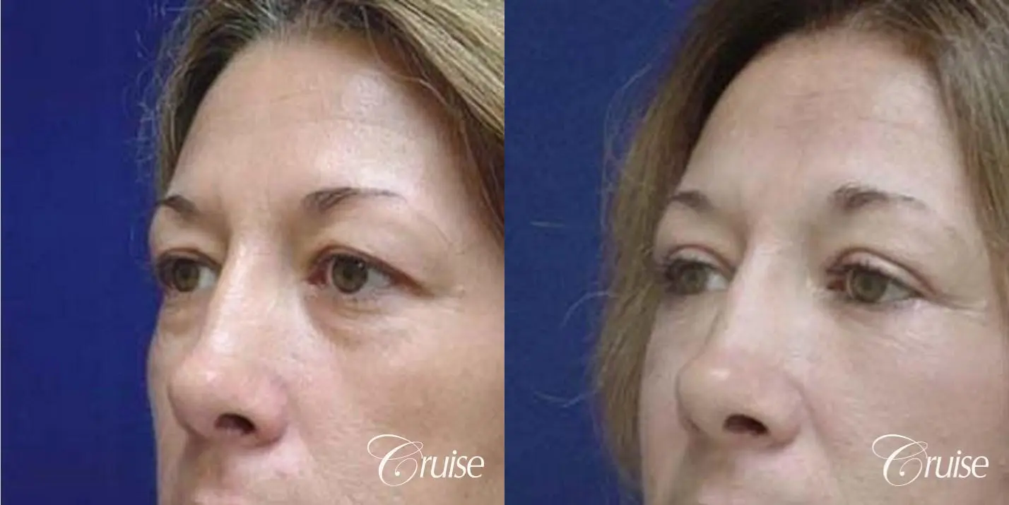 Fat Transfer - Lower Lids, Tear Trough - Before and After 2