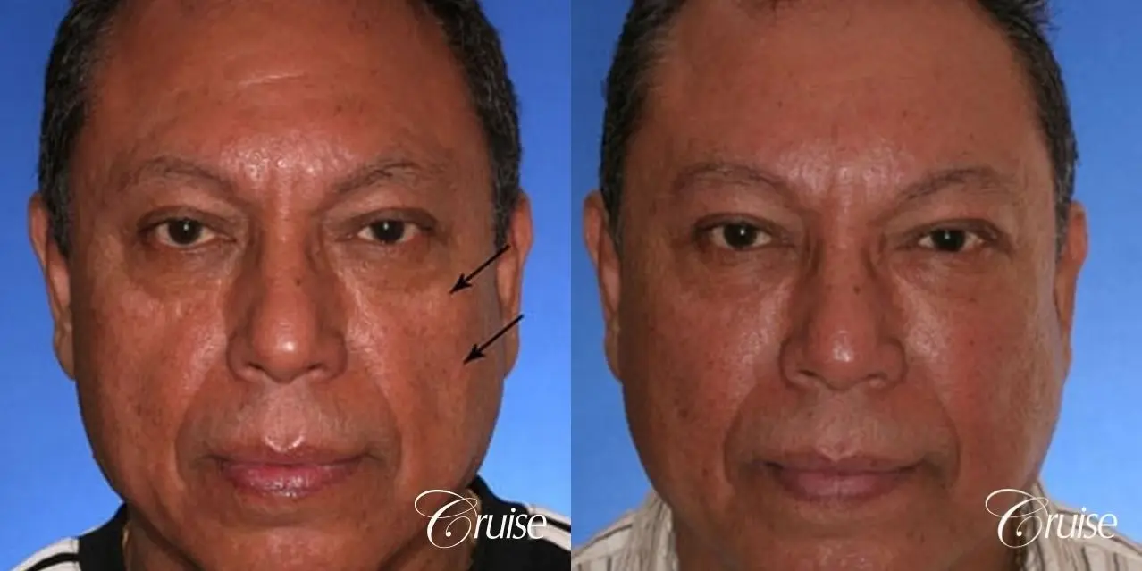 Fat Transfer - Tear Trough, Lower- Lids, Cheeks - Before and After 1