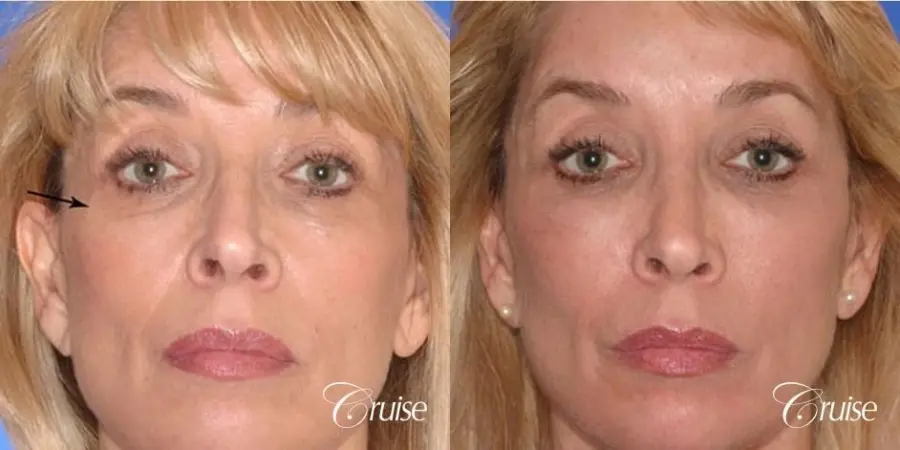 great facial fat transfer result woman - Before and After