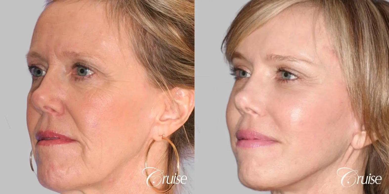 Female Facelift, NeckLift, Neck Midline Plication, Fat Transfer - Before and After 2