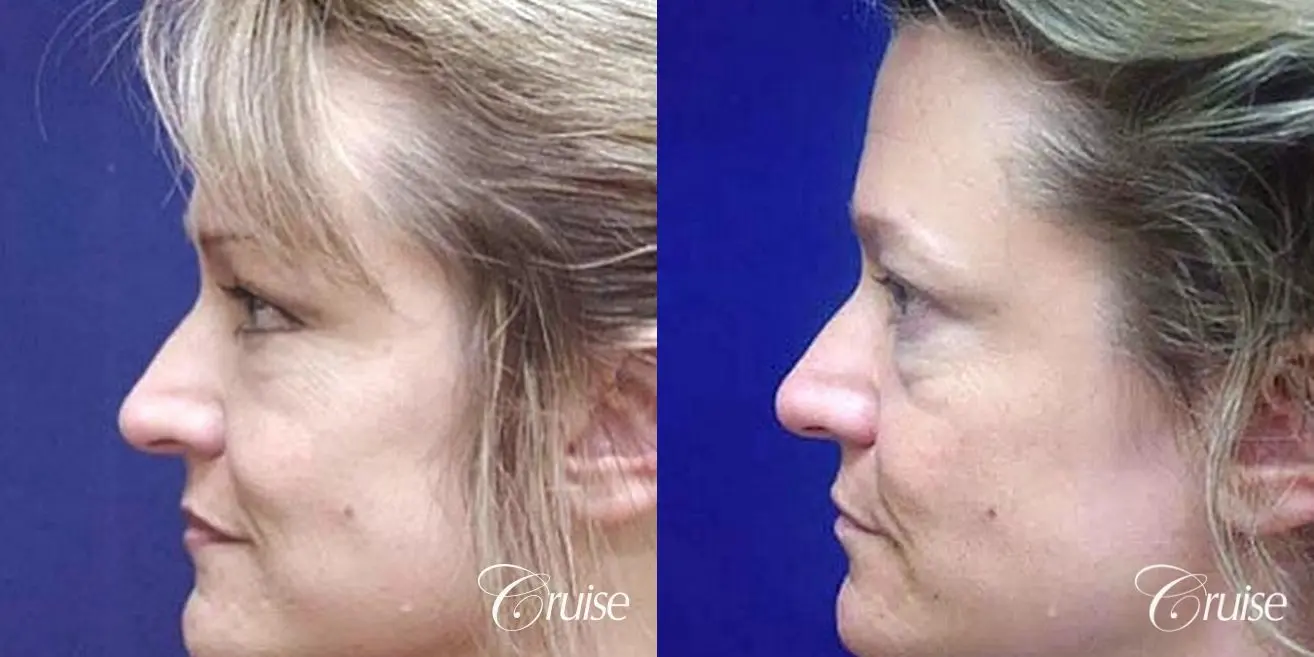 Fat Transfer - Tear Tough, Lower-Lids - Before and After 2