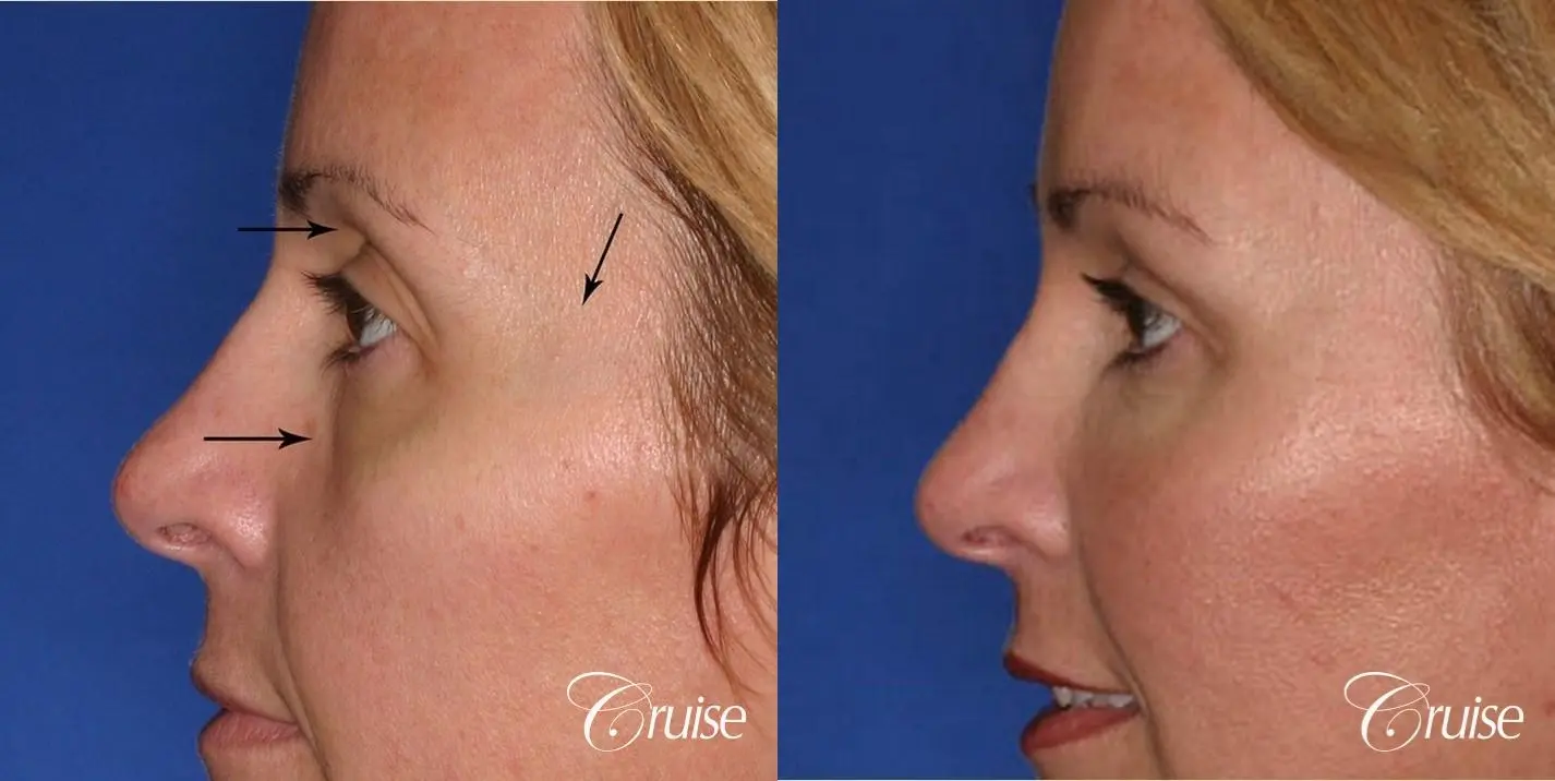 Fat Transfer - Tear Trough, Upper-Lids, Temple - Before and After 4