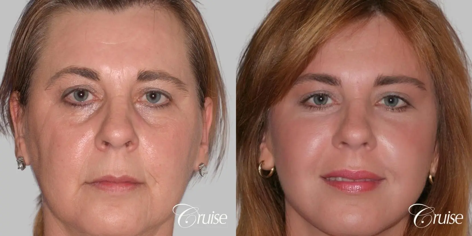 Facelift in Newport Beach, CA - Before and After 1