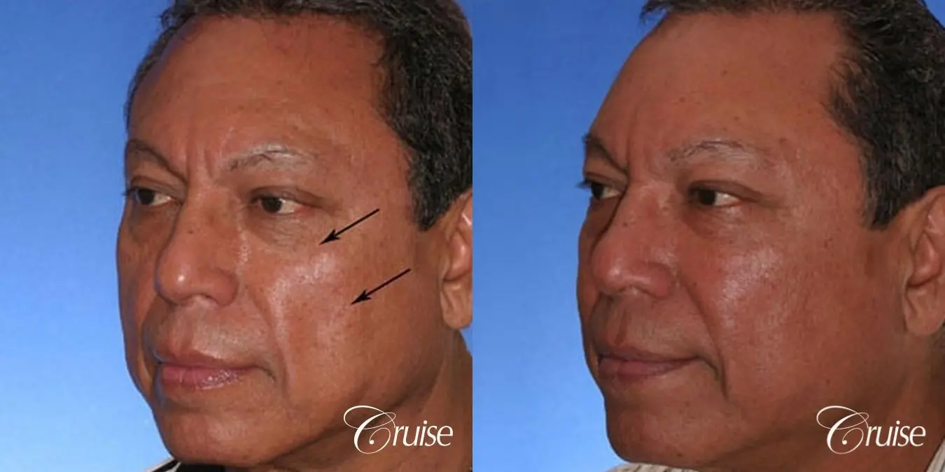 Fat Transfer - Tear Trough, Lower- Lids, Cheeks - Before and After 2