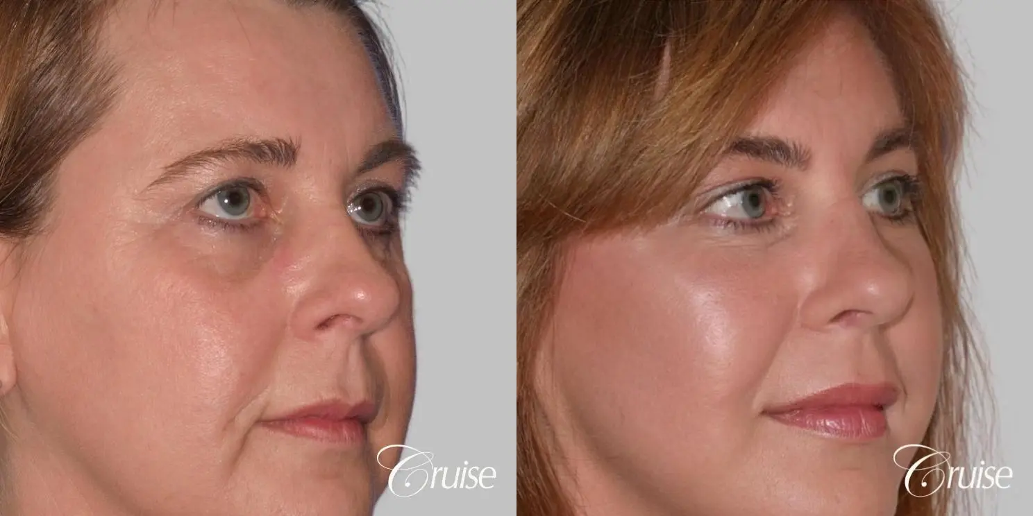 Facelift in Newport Beach, CA - Before and After 2