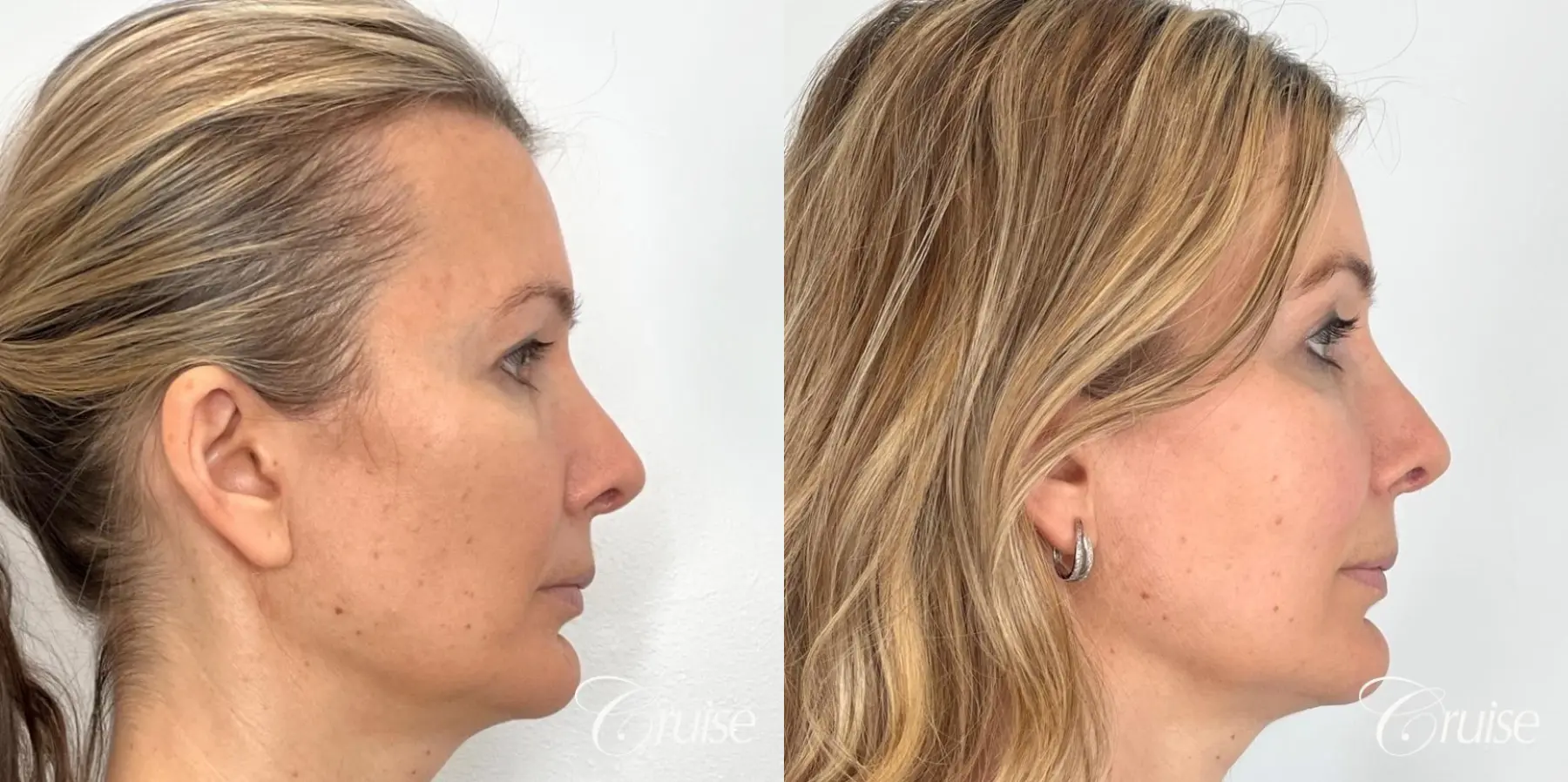 Fat Transfer for Facial Rejuvenation - Before and After 3