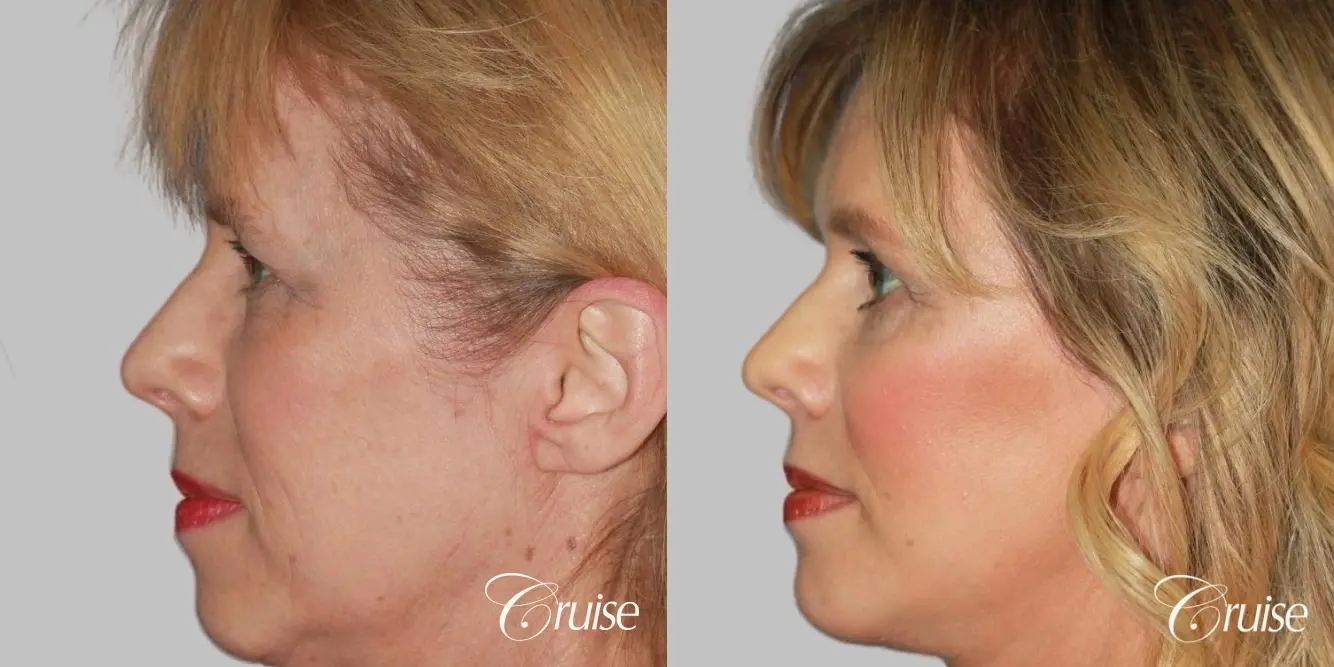 facial rejuvenation newport beach ca - Before and After 2