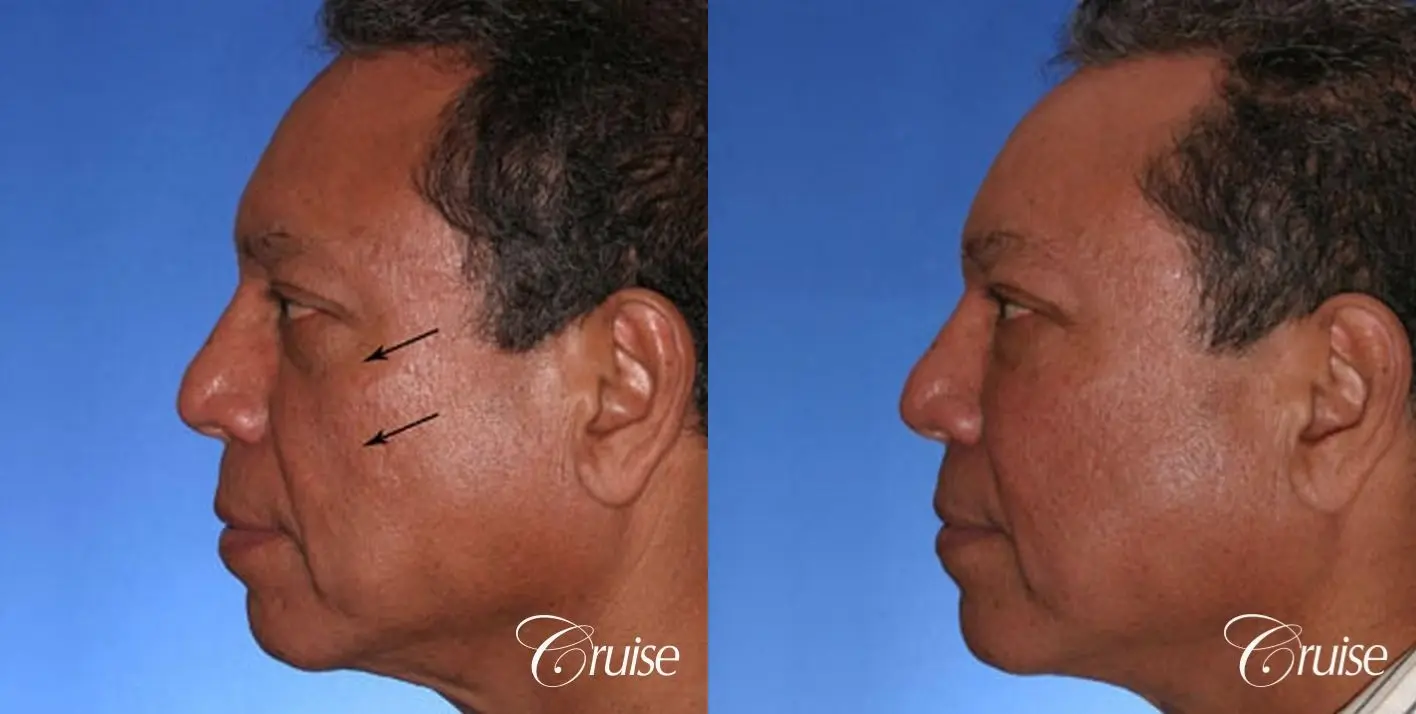 Fat Transfer - Tear Trough, Lower- Lids, Cheeks - Before and After 3