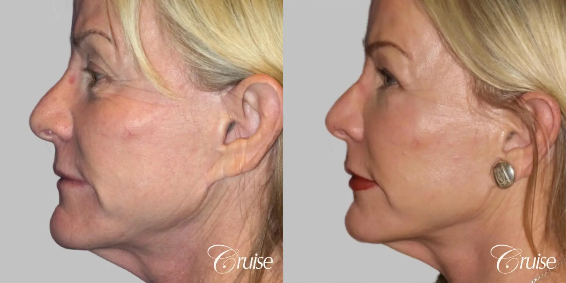 Fat transfer face before and after photos - Before and After 2