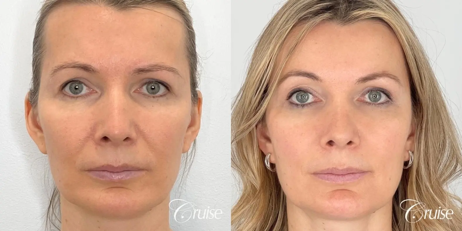 Fat Transfer for Facial Rejuvenation - Before and After 1