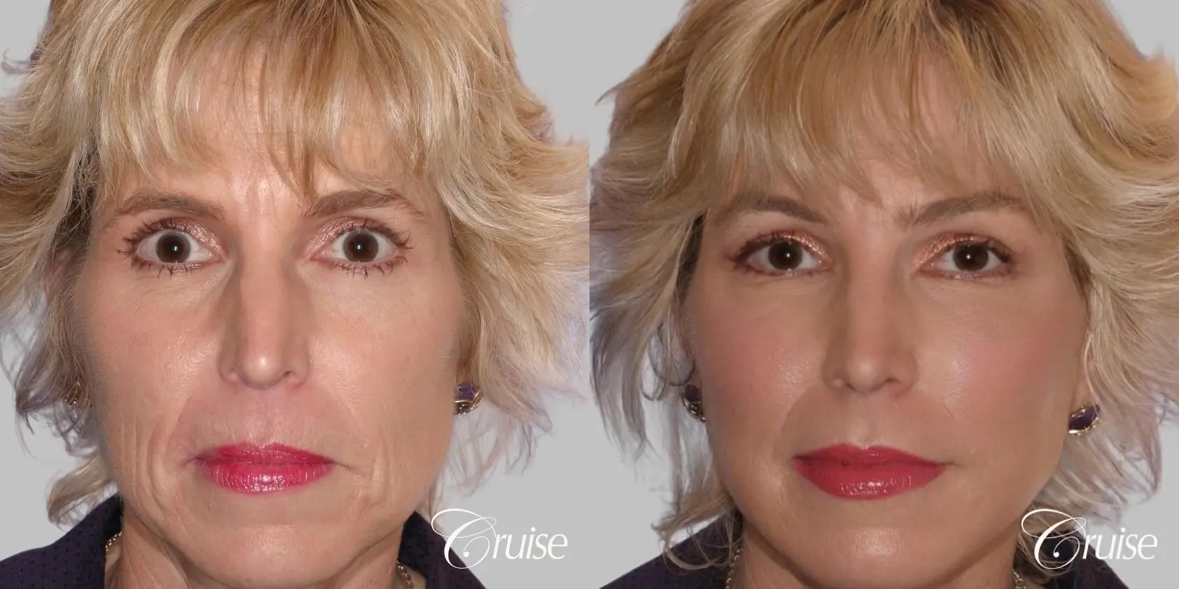 Facelift in Newport Beach, CA - Before and After 1