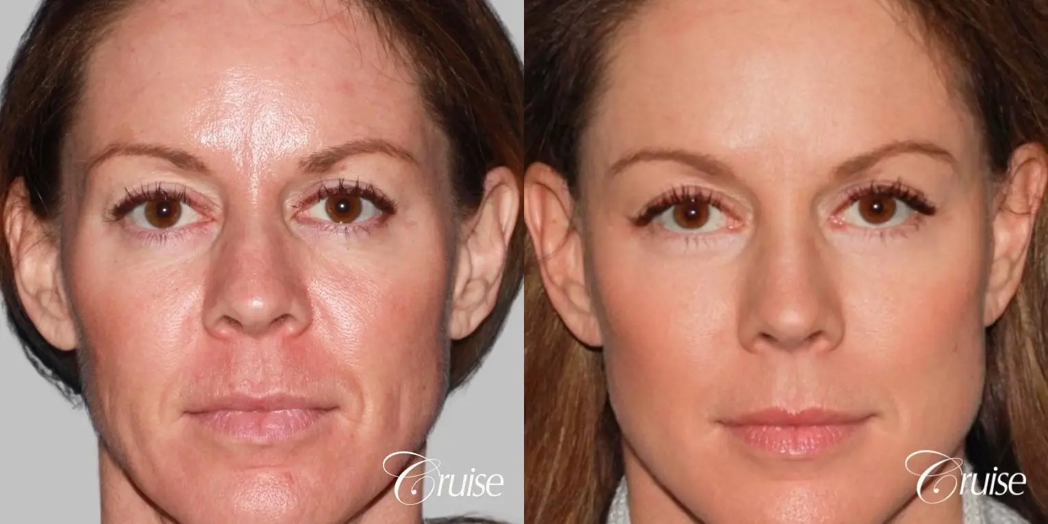 Facelift in Newport Beach, CA - Before and After 1
