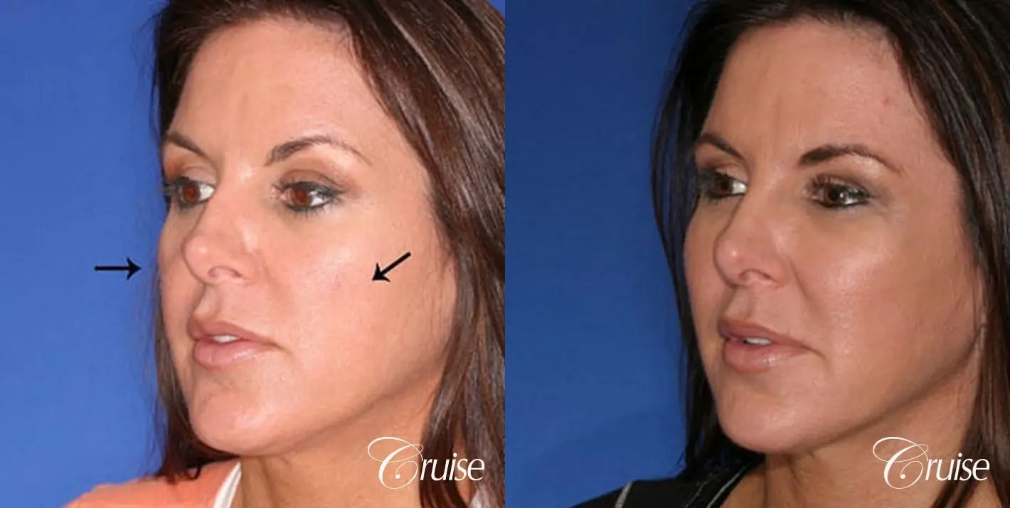 Fat Transfer - Temple, Tear Trough, Lower Lids, Cheeks - Before and After 3