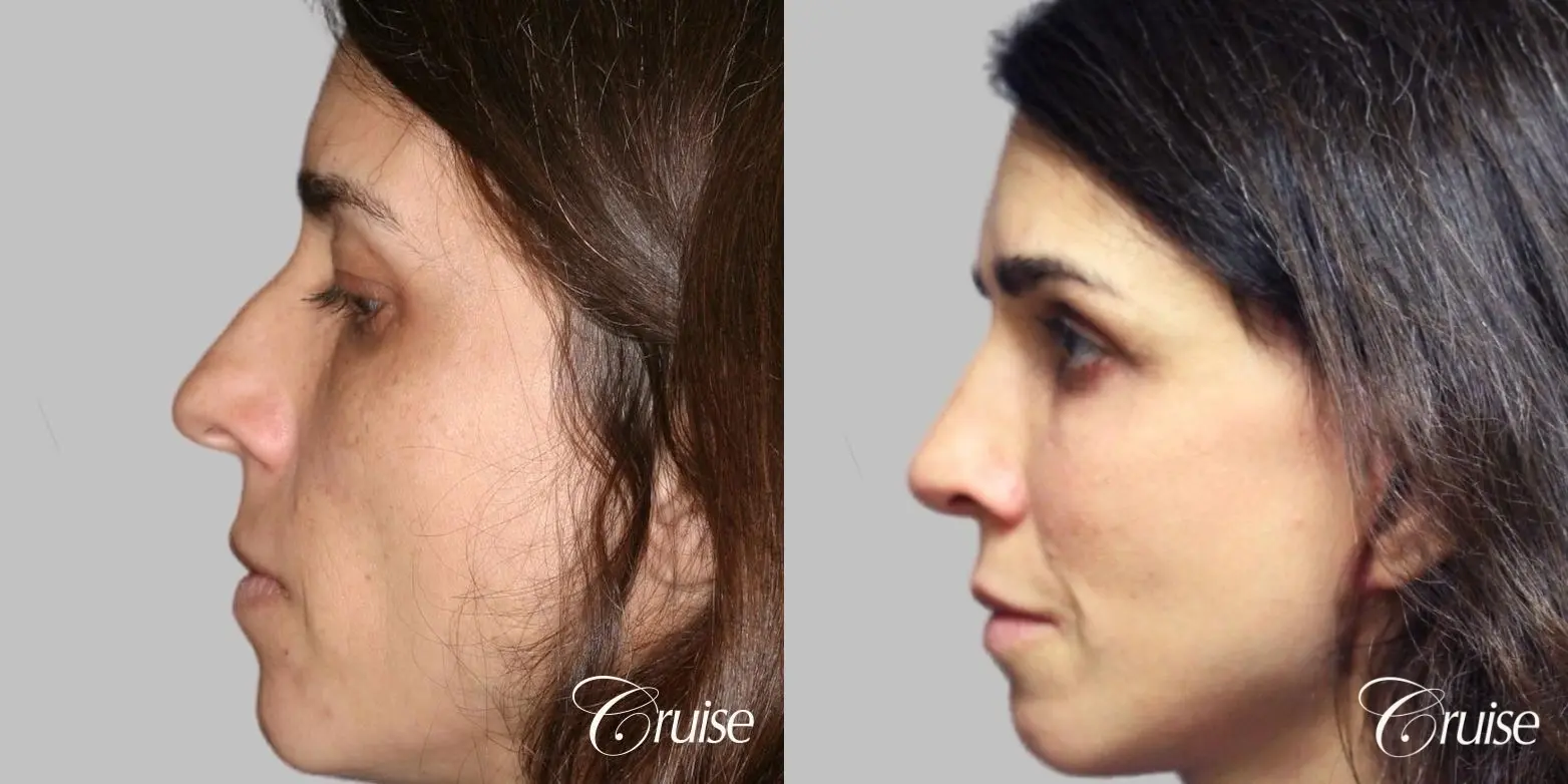 complete facial rejuvenation orange county - Before and After 2