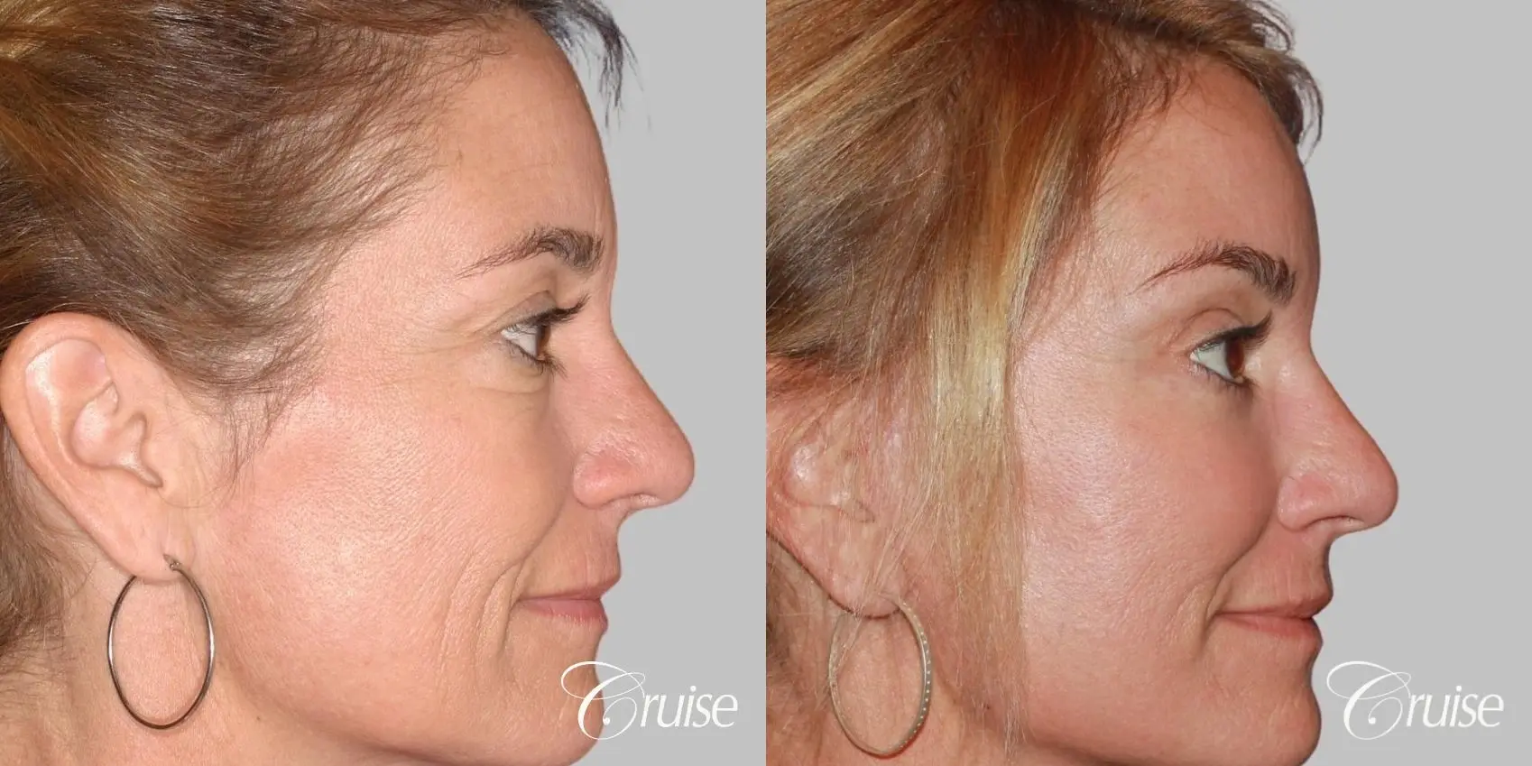Female - Facelift, Neck Tightening, Fat Transfer - Before and After 3