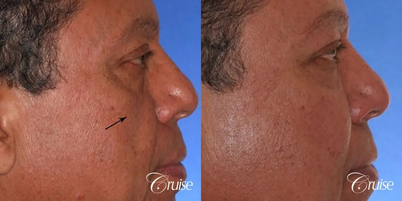 Fat Transfer - Tear Trough, Lower- Lids, Cheeks - Before and After 4