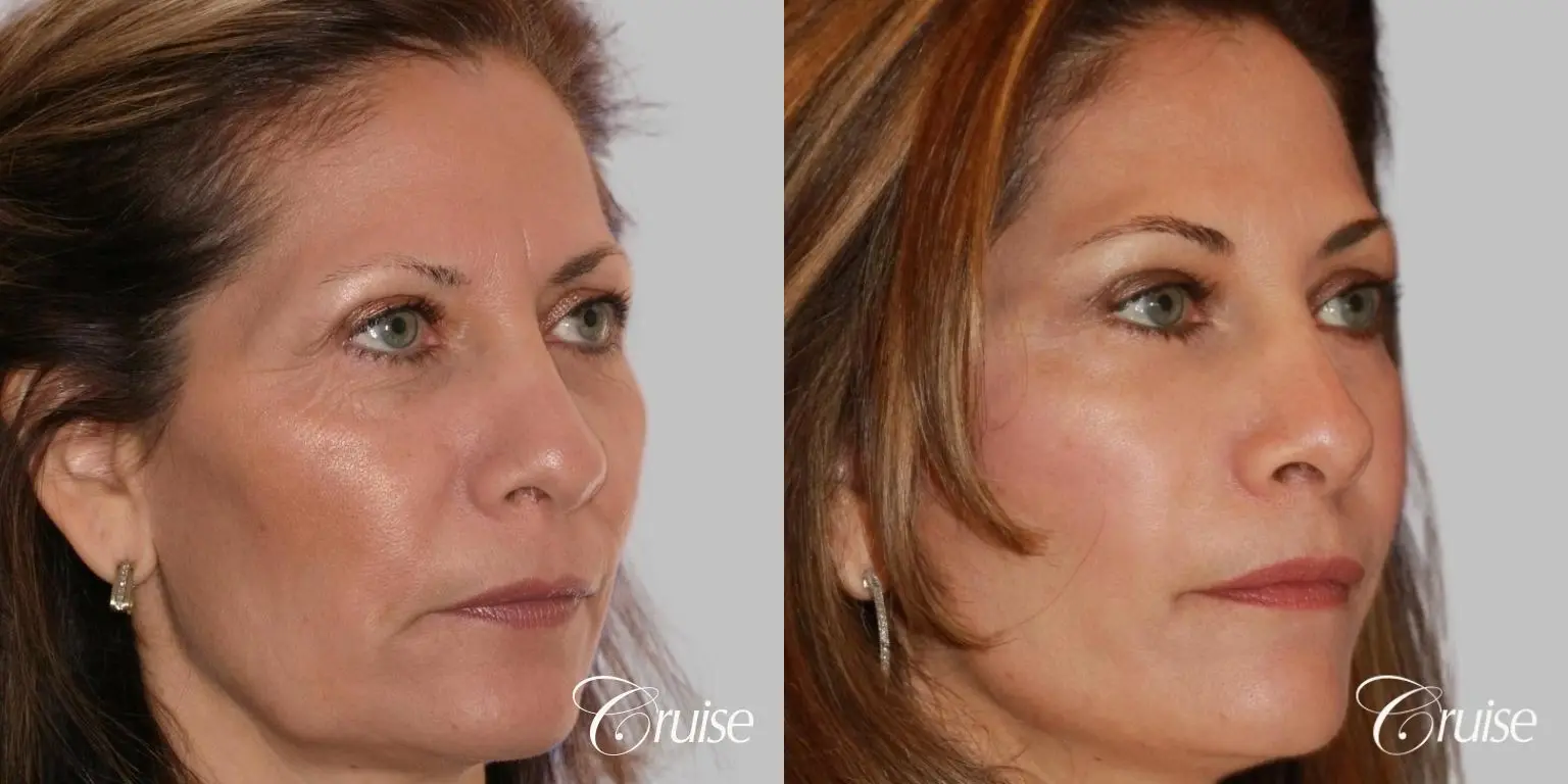 Face Lift, Fat Transfer, Temple Lift - Before and After 3