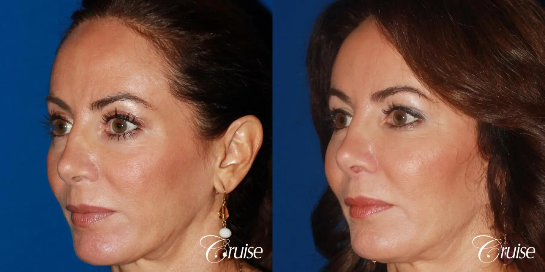 Fat Transfer - Face: Patient 36 - Before and After 3