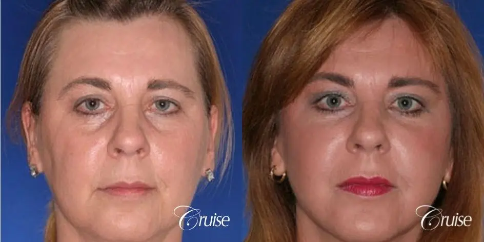 Fat Transfer - Tear Trough, Lower-Lids - Before and After 1
