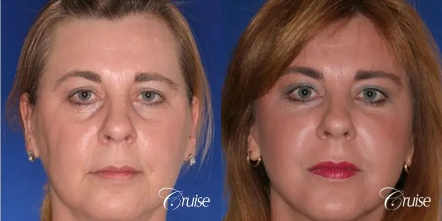 Fat Transfer - Tear Trough, Lower-Lids - Before and After  