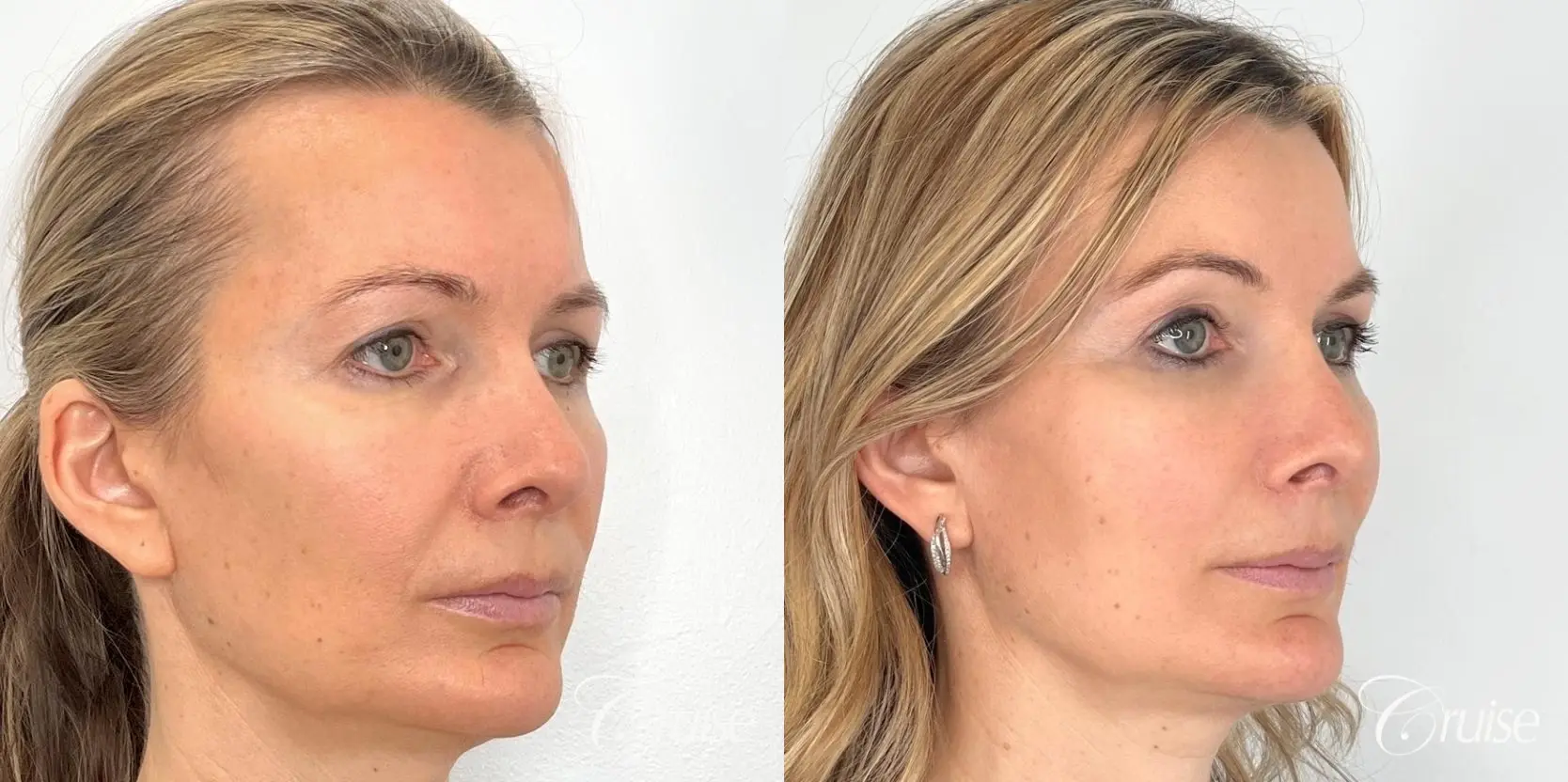 Fat Transfer for Facial Rejuvenation - Before and After 2