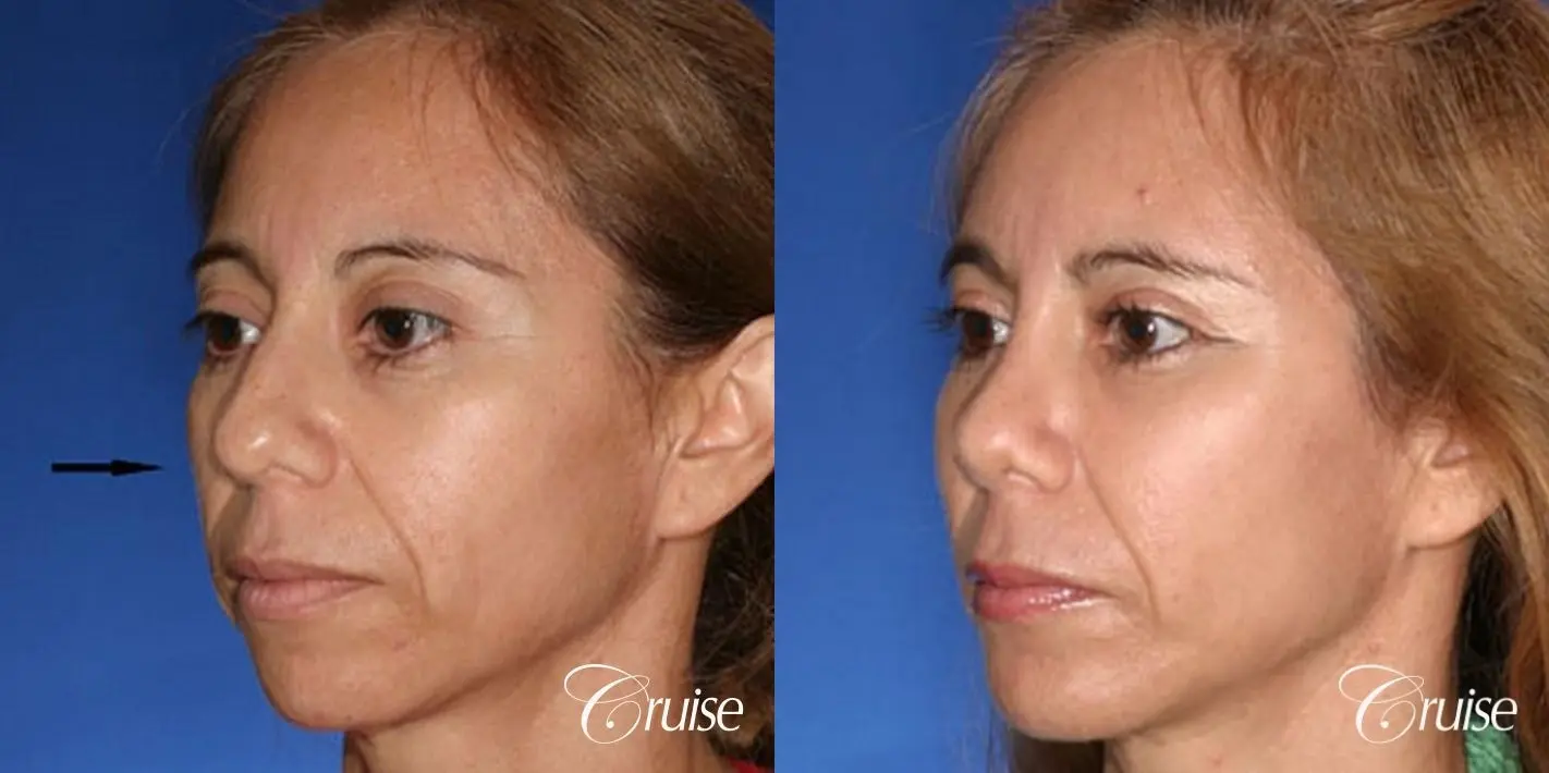 Fat Transfer - Tear Trough, Forehead, Upper Lids, Cheeks - Before and After 3