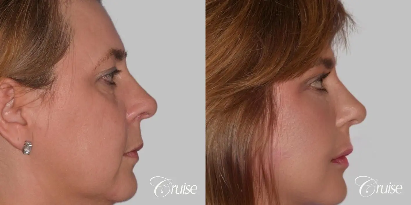 Facelift in Newport Beach, CA - Before and After 3