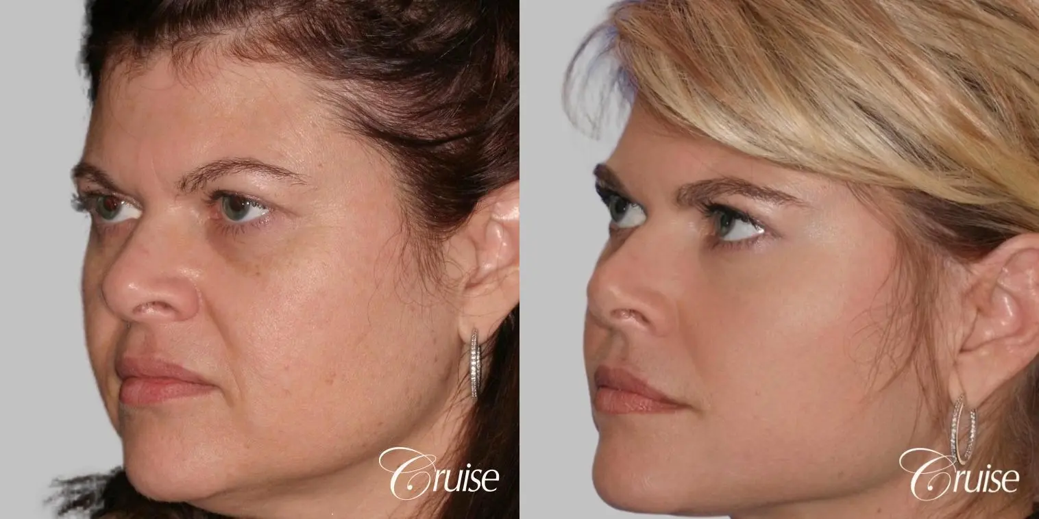 Facelift, Necklift, Temple Lift, Upper Eyelid Surgery, Fat Transfer, Buckle Fat Removal - Before and After 2