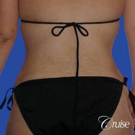 best liposuction tummy tuck - After Image 3