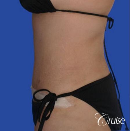 best liposuction tummy tuck - After Image 2