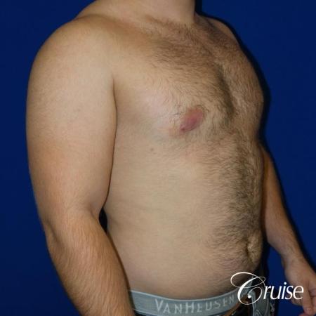 best gynecomastia results - After Image 4